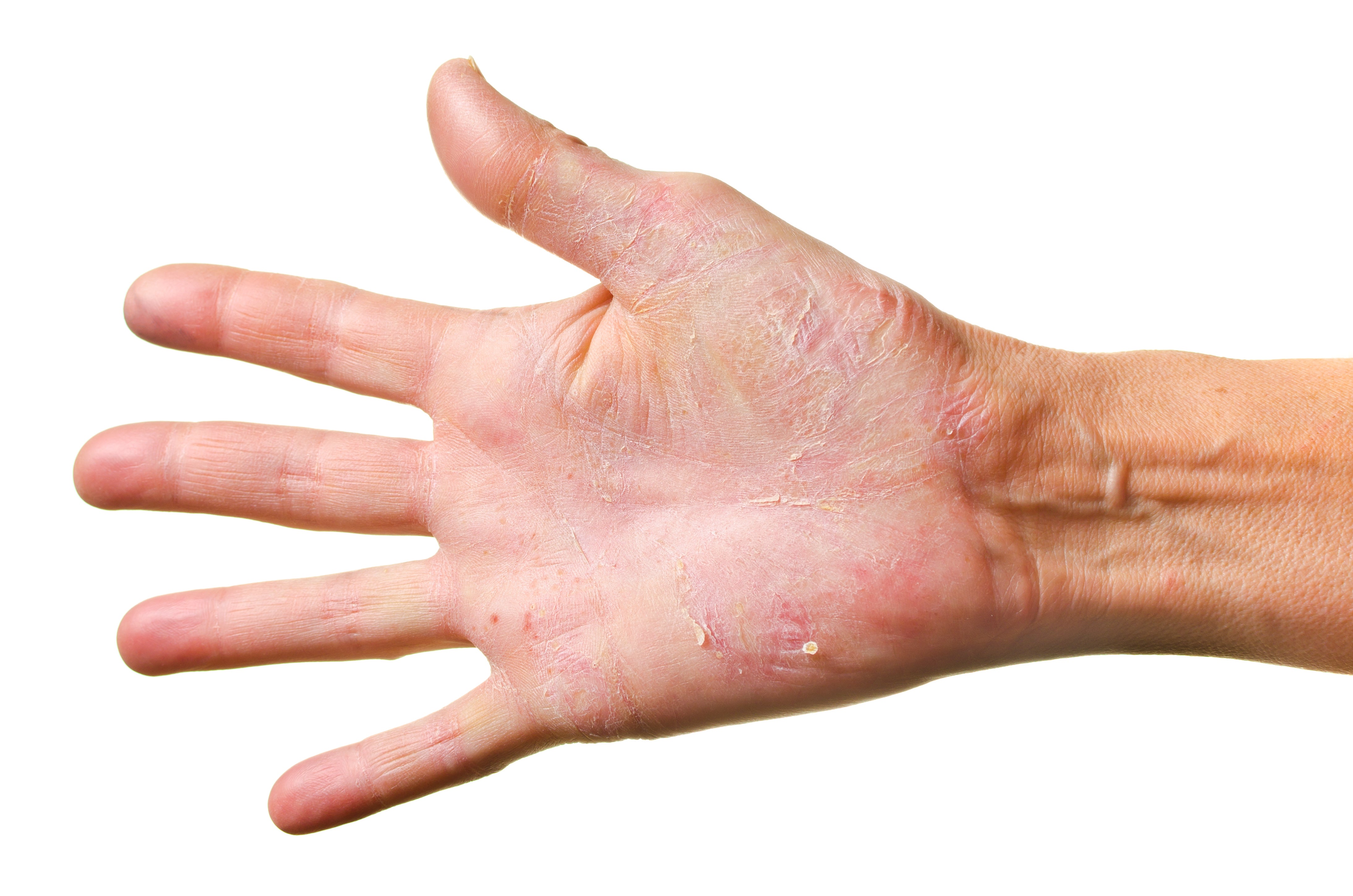 Eczema & Dry Skin