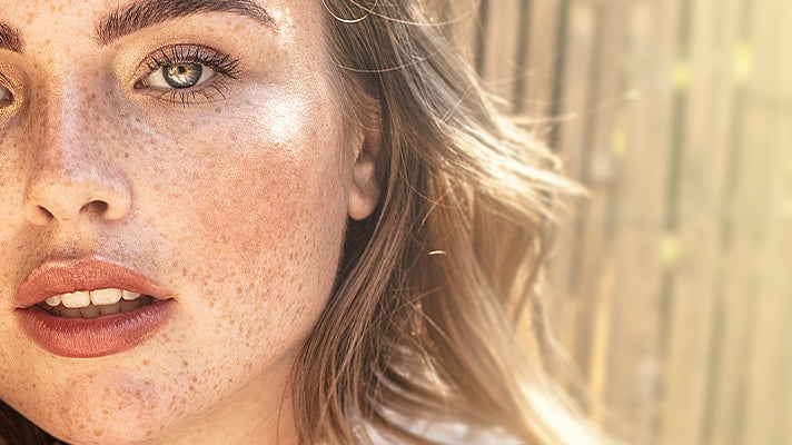 Skin Discoloration: How to Treat & Prevent