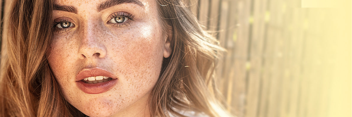 Skin Discoloration: How to Treat & Prevent