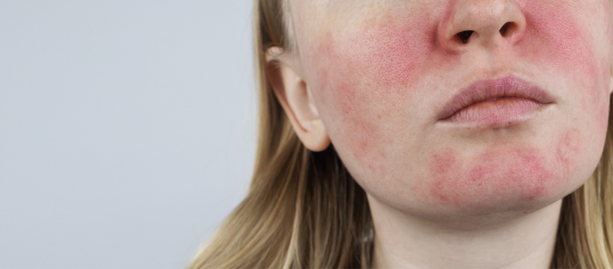 Rosacea