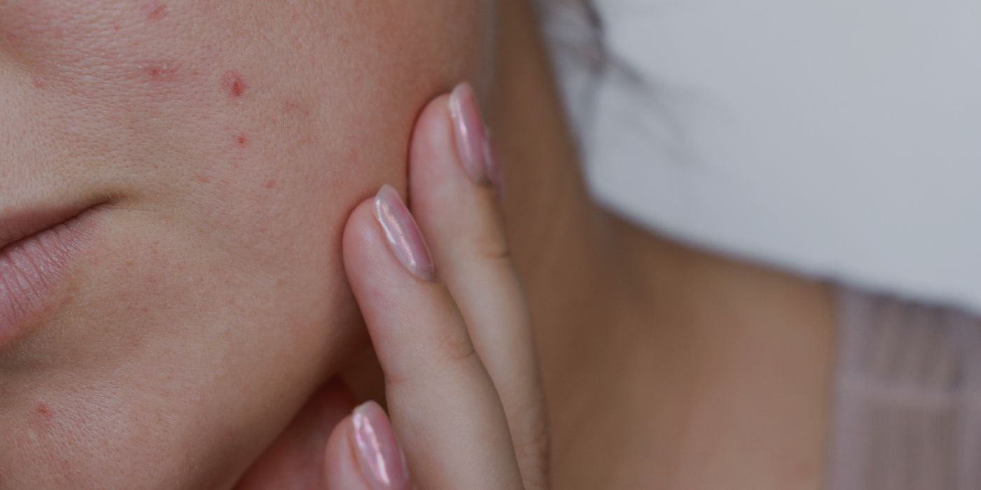 Acne